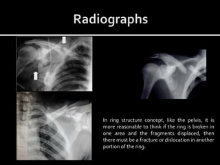 In ring structure concept, like the pelvis, it is
more reasonable to think if the ring is broken in
one area and the fragments displaced, then
there must be a fracture or dislocation in another
portion of the ring.
 