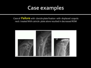 Case of Failure with clavicle plate fixation with displaced scapula
neck treated With calvicle plate alone resulted in decreased ROM
 