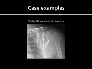 Double Plating done at the same time
 