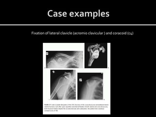 Fixation of lateral clavicle (acromio clavicular ) and coracoid (c4)
 