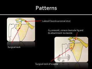 Surgical neck
Lateral Clavicle acromial strut
C4 coracoid , coraco clavicular lig and
Its attachment to clavicle
Surgical neck of scapula
 