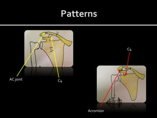 AC joint C4
Acromion
C4
 
