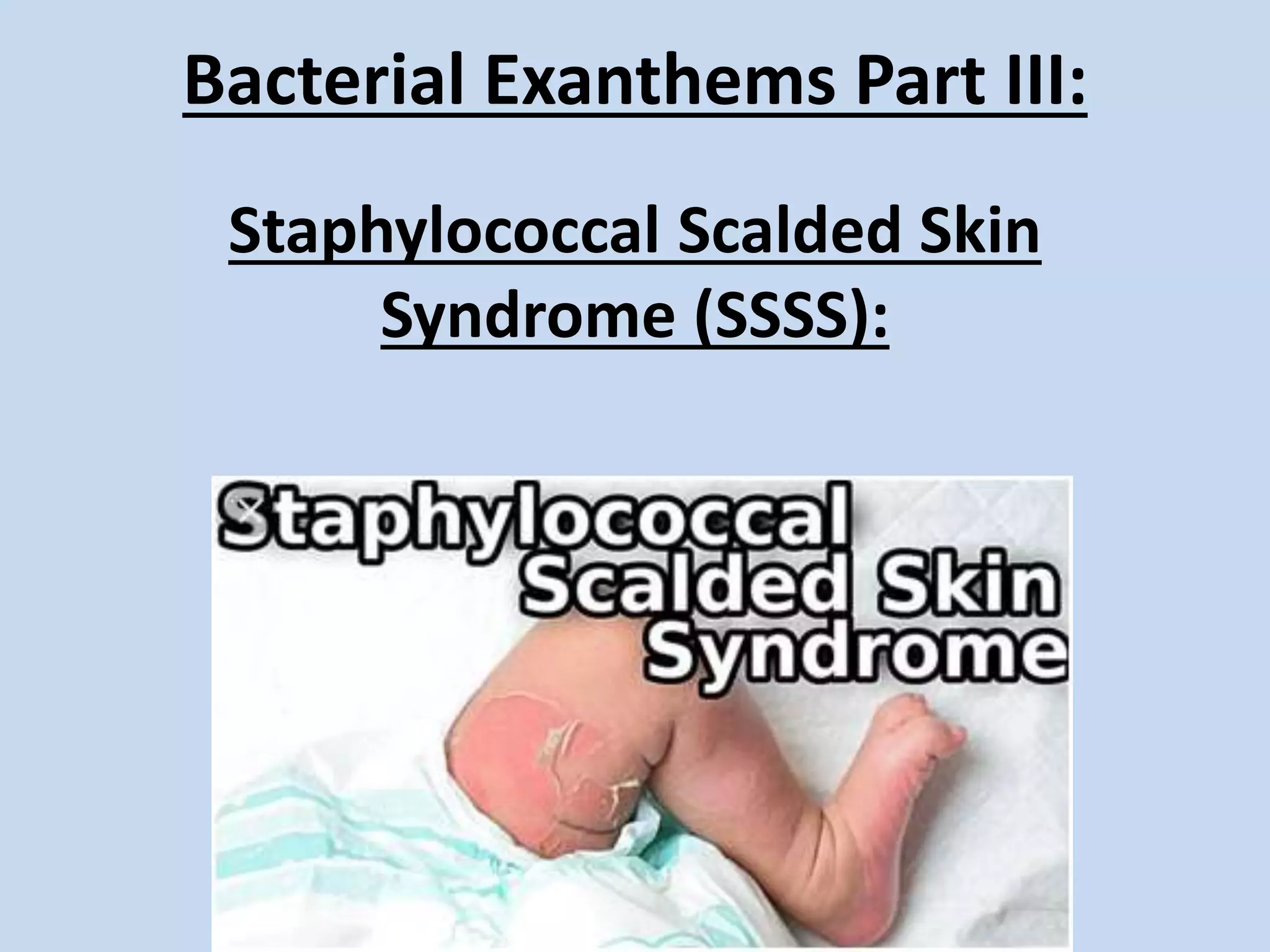 Staphylococcal Scalded Skin Syndrome Made Very Easy PPTX