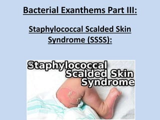 Bacterial Exanthems Part III:
Staphylococcal Scalded Skin
Syndrome (SSSS):
 