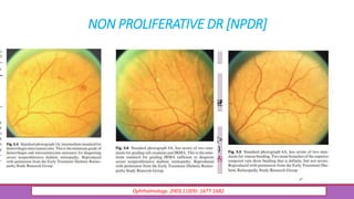 NON PROLIFERATIVE DR [NPDR]
Ophthalmology. 2003;110(9): 1677-1682.
• MICROANEURYSMS onlyMILD
• MICROANEURYSMS
• Other signs :
DOT & BLOT HAEMORRHAGES,
HARD EXUDATES, COTTON WOOL SPOTS
MODERATE
• INTRARETINAL HAEMORRHAGES (>20 in each quadrant)
• VENOUS BEADING (in 2 quadrants)
• INTRARETINAL MICROVASCULAR ABNORMALITIES(IRMA) (in 1
quadrant)
SEVERE
 