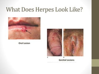 Herpes: Folklore, Fear and Realities