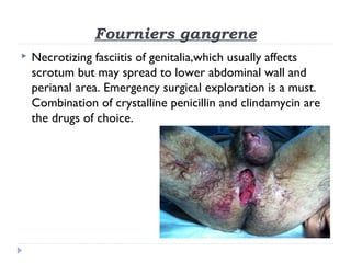 Fourniers gangrene
 Necrotizing fasciitis of genitalia,which usually affects
scrotum but may spread to lower abdominal wall and
perianal area. Emergency surgical exploration is a must.
Combination of crystalline penicillin and clindamycin are
the drugs of choice.
 