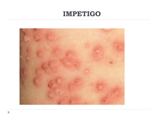 IMPETIGO
 