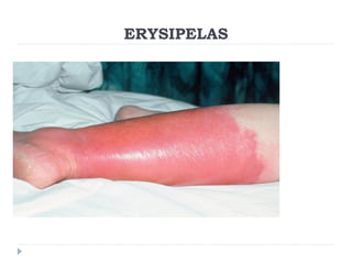 ERYSIPELAS
 