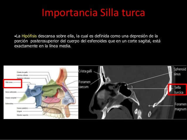 silla turca s 237 ndrome silla turca vac 237 a silla turca s 237 ndrome silla turca vac 237 a