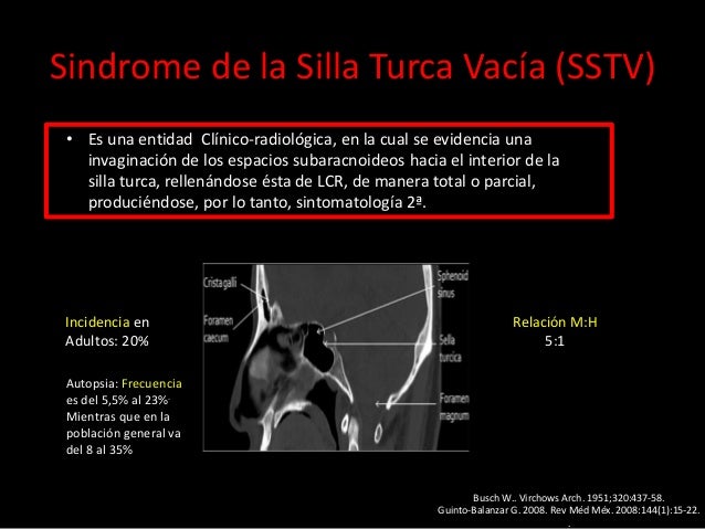 silla turca s 237 ndrome silla turca vac 237 a silla turca s 237 ndrome silla turca vac 237 a