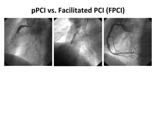 pPCI vs. Facilitated PCI (FPCI)
 
