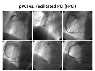 pPCI vs. Facilitated PCI (FPCI)
 