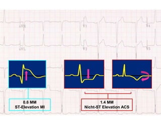 1.4 MM
Nicht-ST Elevation ACS
0.6 MM
ST-Elevation MI
 