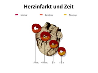 Herzinfarkt und Zeit
Normal Ischämie Nekrose
15 min. 40 min. 3 h ≥ 6 h
 