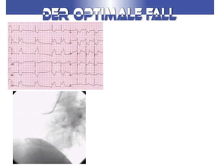 akutes Koronarsyndrom