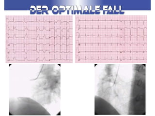 akutes Koronarsyndrom