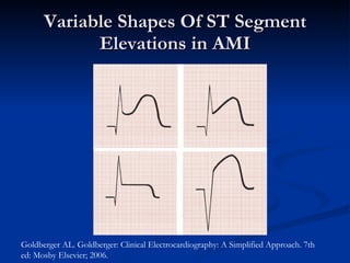Variable Shapes Of ST Segment Elevations in AMI Goldberger AL. Goldberger: Clinical Electrocardiography: A Simplified Approach. 7th ed: Mosby Elsevier; 2006. 
