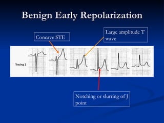 Benign Early Repolarization Notching or slurring of J point Concave STE Large amplitude T wave 