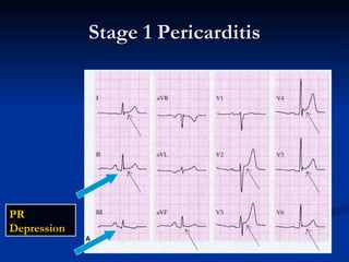 Stage 1 Pericarditis PR Depression  