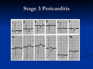 Stage 3 Pericarditis 