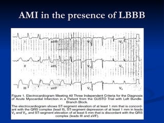 AMI in the presence of LBBB 