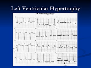 Left Ventricular Hypertrophy 