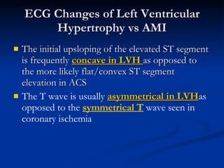 The initial upsloping of the elevated ST segment is frequently  concave in LVH  as opposed to the more likely flat/convex ST segment elevation in ACS The T wave is usually  asymmetrical in LVH as opposed to the  symmetrical T  wave seen in coronary ischemia ECG Changes of Left Ventricular Hypertrophy vs AMI 