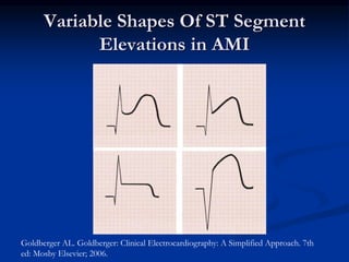 Variable Shapes Of ST Segment
Elevations in AMI
Goldberger AL. Goldberger: Clinical Electrocardiography: A Simplified Approach. 7th
ed: Mosby Elsevier; 2006.
 