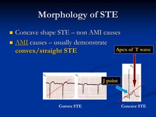 Morphology of STE
 Concave shape STE – non AMI causes
 AMI causes – usually demonstrate
convex/straight STE
J point
Apex of T wave
Concave STE
Convex STE
 