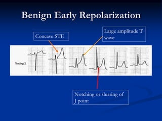 Notching or slurring of
J point
Concave STE
Benign Early Repolarization
Large amplitude T
wave
 