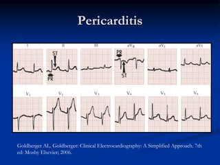 Pericarditis
Goldberger AL. Goldberger: Clinical Electrocardiography: A Simplified Approach. 7th
ed: Mosby Elsevier; 2006.
 