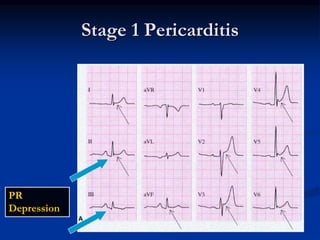 Stage 1 Pericarditis
PR
Depression
 