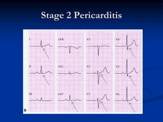 Stage 2 Pericarditis
 
