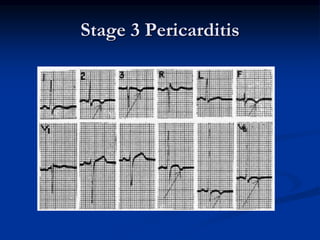 Stage 3 Pericarditis
 