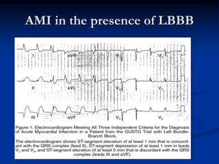 AMI in the presence of LBBB
 