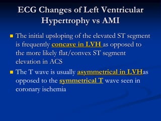  The initial upsloping of the elevated ST segment
is frequently concave in LVH as opposed to
the more likely flat/convex ST segment
elevation in ACS
 The T wave is usually asymmetrical in LVHas
opposed to the symmetrical T wave seen in
coronary ischemia
ECG Changes of Left Ventricular
Hypertrophy vs AMI
 