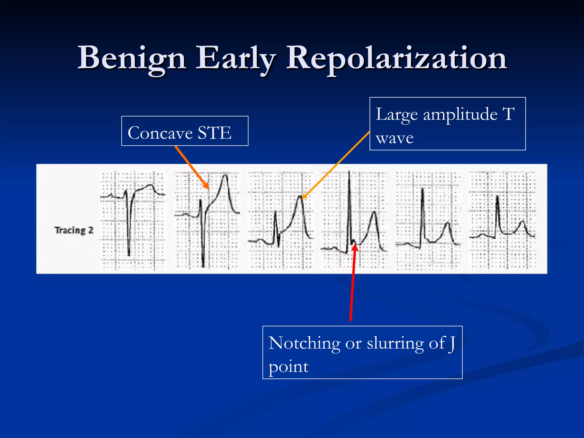 Benign Early Repolarization Notching or slurring of J point Concave STE Large amplitude T wave 