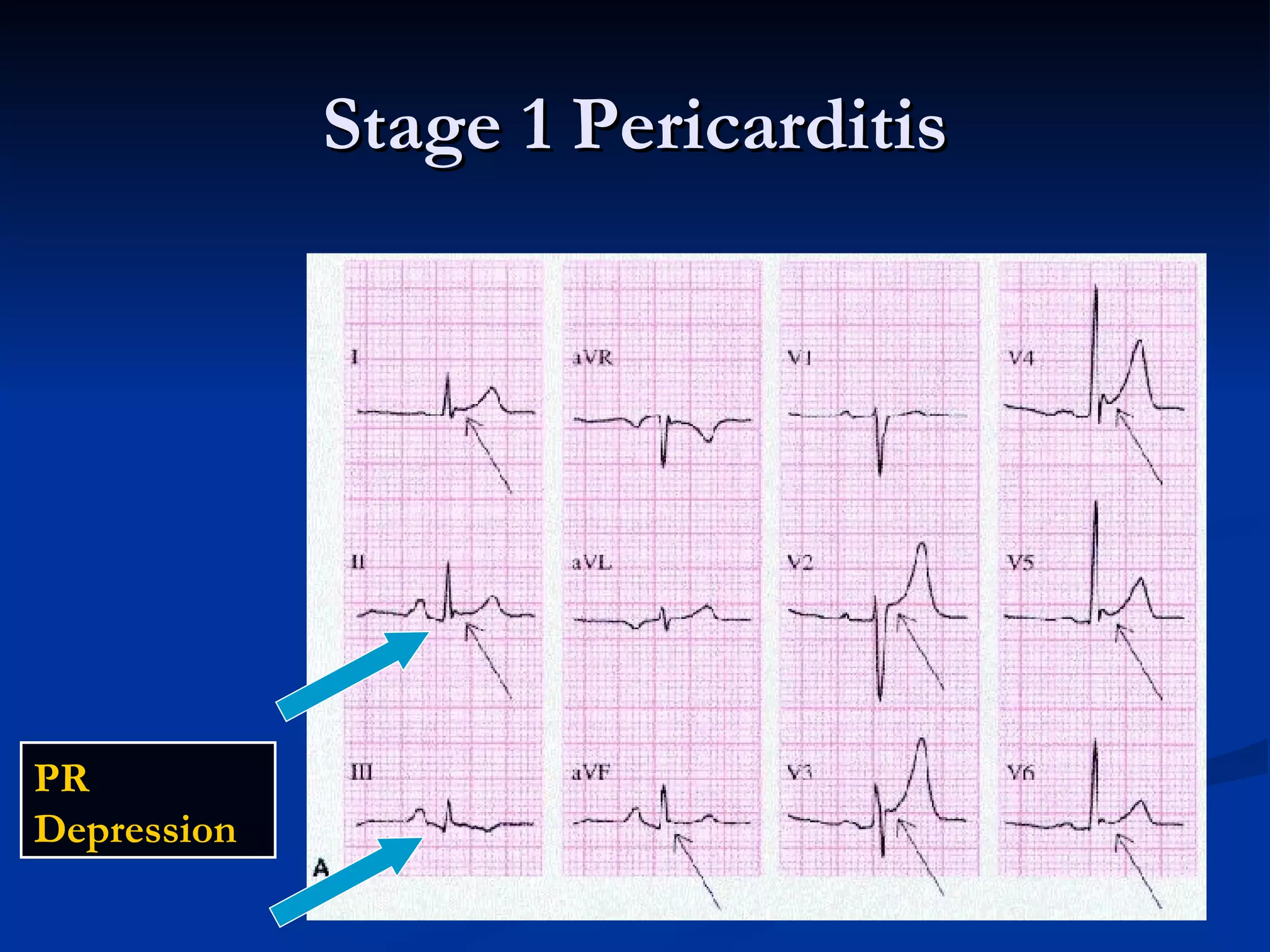 Stage 1 Pericarditis PR Depression  