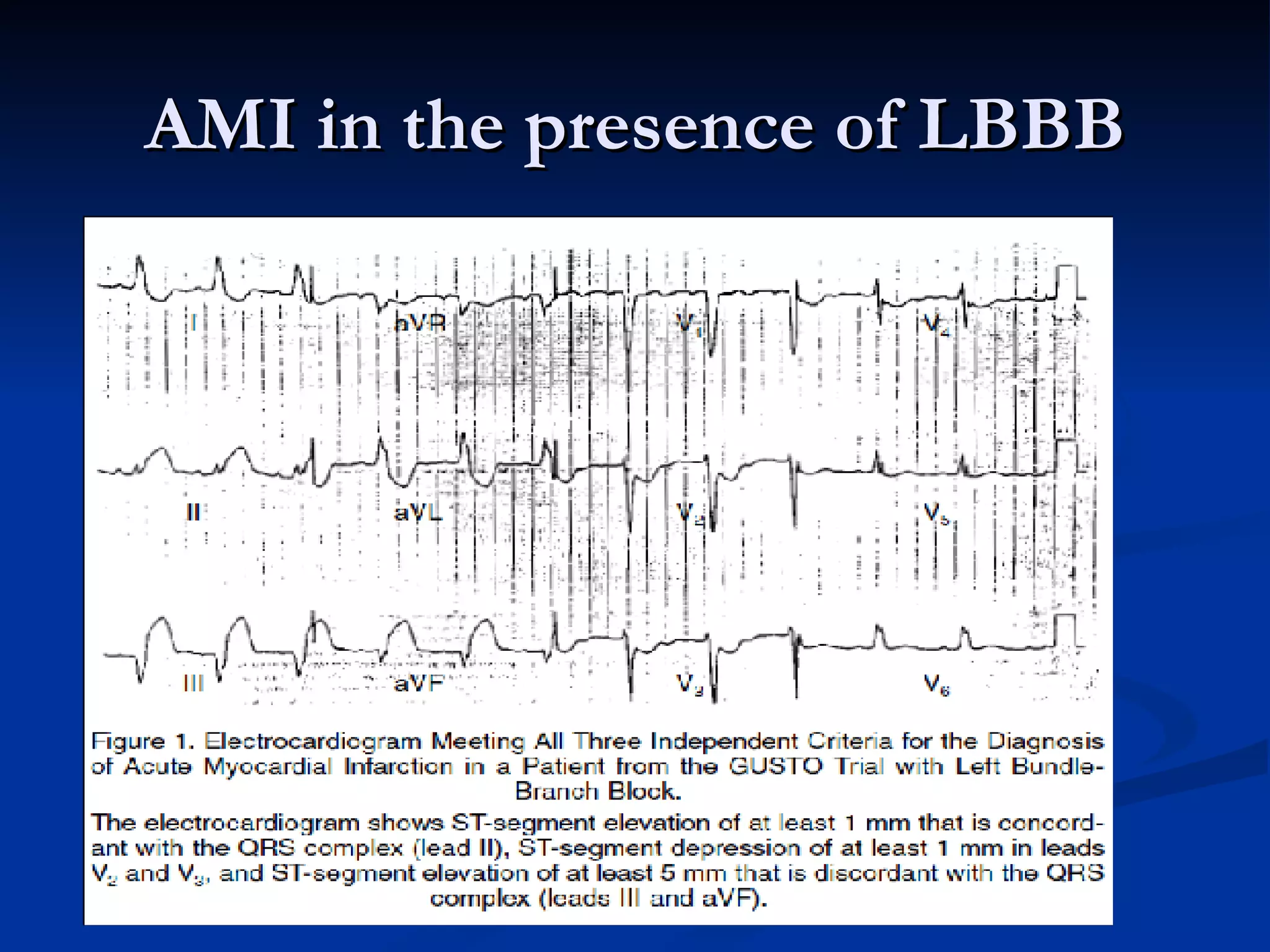 AMI in the presence of LBBB 