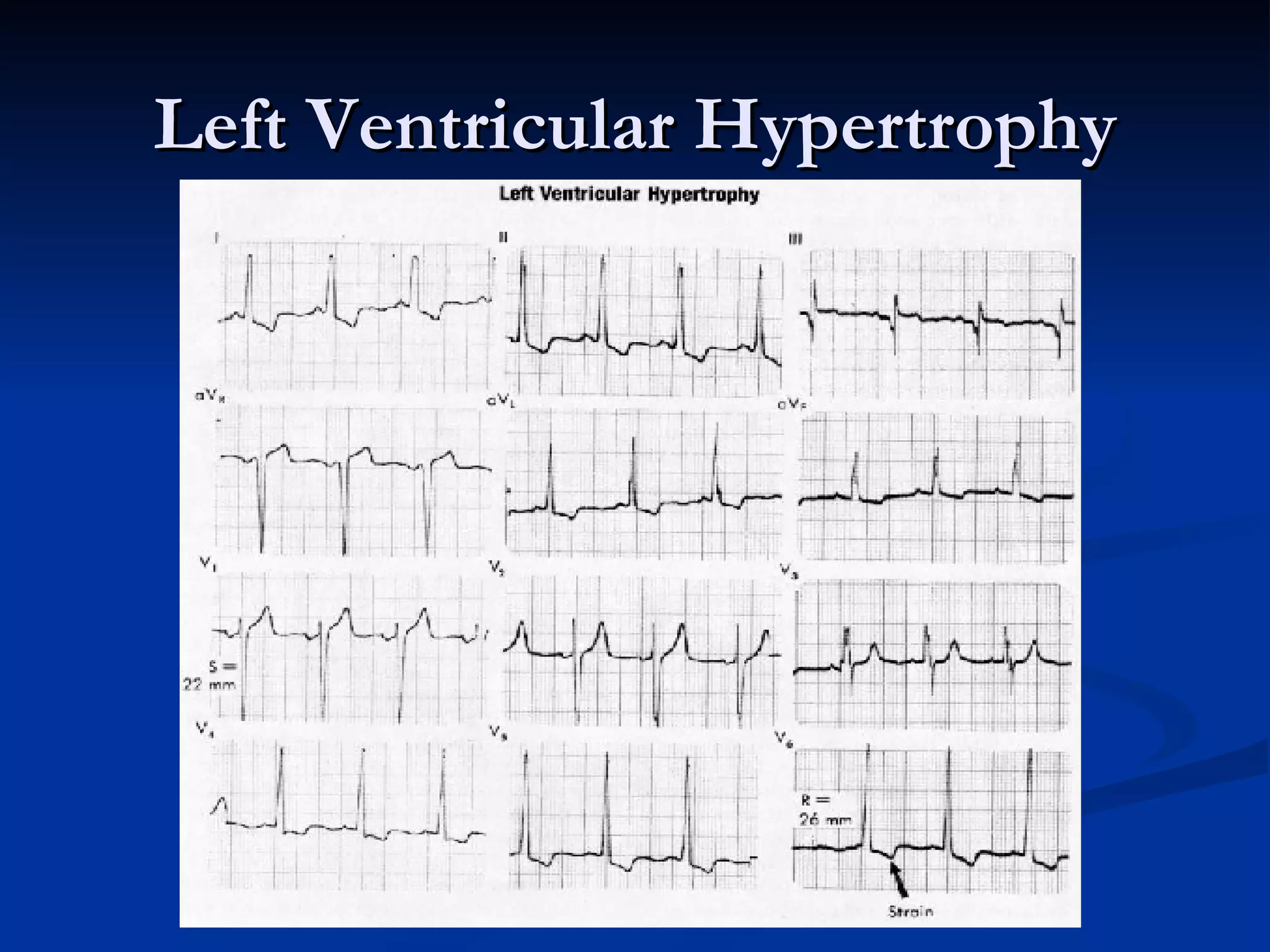 Left Ventricular Hypertrophy 