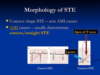 Morphology of STE <ul><li>Concave shape STE – non AMI causes </li></ul><ul><li>AMI  causes – usually demonstrate  convex/s...