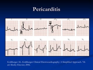 Pericarditis Goldberger AL. Goldberger: Clinical Electrocardiography: A Simplified Approach. 7th ed: Mosby Elsevier; 2006. 
