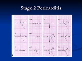 Stage 2 Pericarditis 