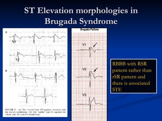 ST Elevation morphologies in Brugada Syndrome RBBB with RSR pattern rather than rSR pattern and there is associated STE 
