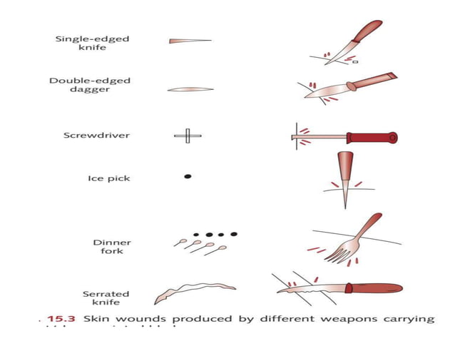 Stab and chop wounds mb singh 2020 | PPTX | First Aid | Injuries