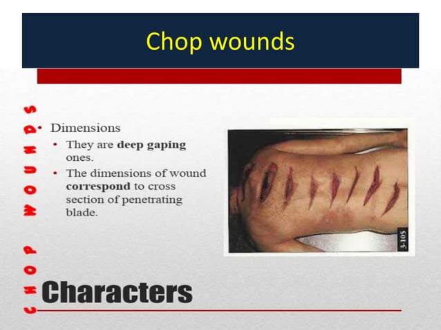 Stab and chop wounds mb singh 2020 | PPTX | First Aid | Injuries