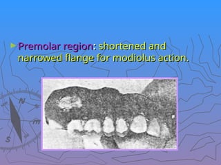 ►Premolar region
Premolar region:
: shortened and
shortened and
narrowed flange for modiolus action.
narrowed flange for modiolus action.
 