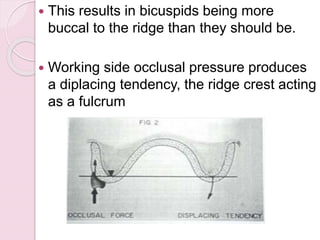  This results in bicuspids being more
buccal to the ridge than they should be.
 Working side occlusal pressure produces
a diplacing tendency, the ridge crest acting
as a fulcrum
 