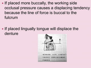 If placed more buccally, the working side
occlusal pressure causes a displacing tendency
because the line of force is buccal to the
fulcrum
 If placed lingually tongue will displace the
denture
 